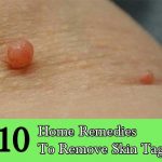 10-Home-Remedies-To-Remove-Skin-Tags-500x413