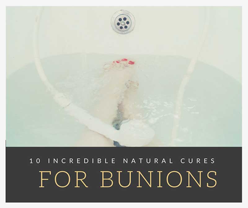10 Natural Bunion Cures