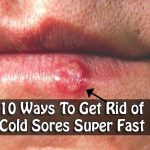 10 Ways To Get Rid of Cold Sores Super Fast