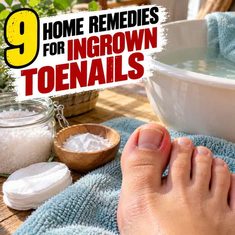9 Home Remedies for Ingrown Toenails 9 Home Remedies for Ingrown Toenails