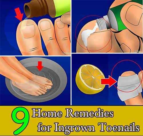 9 Home Remedies for Ingrown Toenails