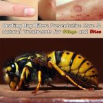 Beating-Bug-Bites-Preventative-Care-and-Natural-Treatments-for-Stings-and-Bites