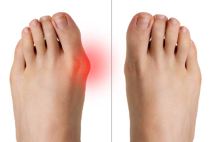 Bunion remedies 