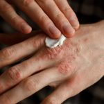 Healing Cream For Eczema And Psoriasis