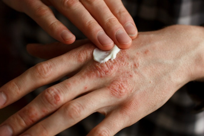 Healing Cream For Eczema And Psoriasis