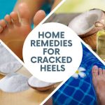 8 Home Remedies for Cracked Heels