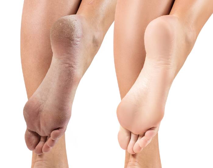 Homemade Cracked Heel Remedy – For Super Soft Feet!