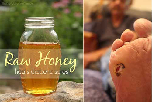 How Raw Honey Helped Save Her Dads Diabetic Foot