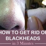 How to Get Rid of Blackheads in 3 Minutes