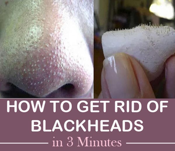 How to Get Rid of Blackheads in 3 Minutes