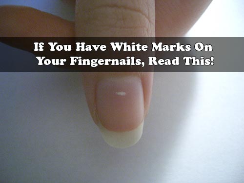 If You Have White Marks On Your Fingernails, Read This!