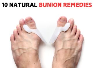 Natural Bunion remedies Natural Bunion Remedies