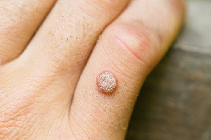 Natural Wart Treatment