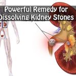 Powerful Remedy for Dissolving Kidney Stones