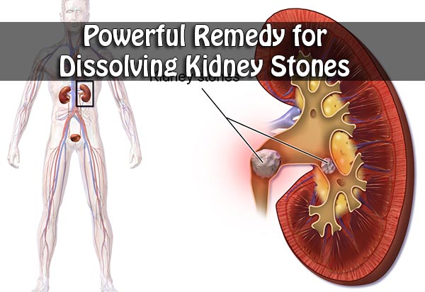 Powerful Remedy for Dissolving Kidney Stones 
