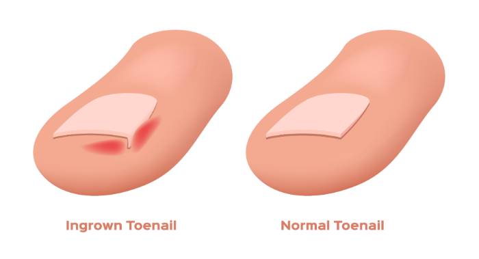 ingrown Toenails